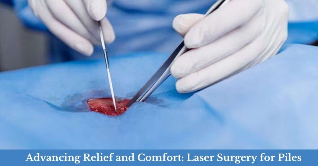 Laser surgery for piles in Indore