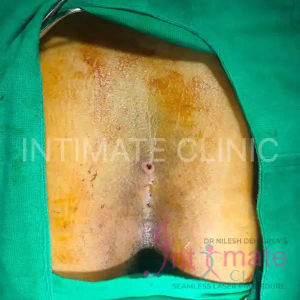 laser pilonidoplasty in indore pre