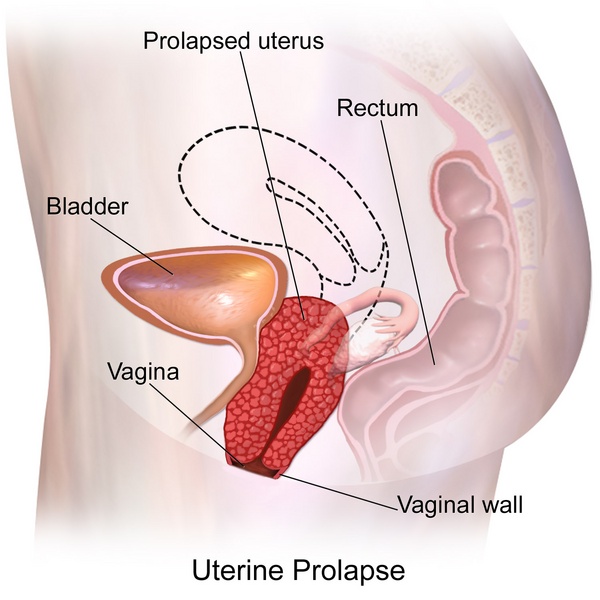 uterine prolapse treatment in indore