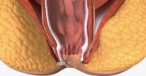 fissure treatment doctor in indore, fissure treatment in indore, fissure surgeon in indore, fissure laser treatment, best fissure treatment doctor in indore, best fissure treatment in indore, best fissure surgeon in indore, best fissure laser treatment