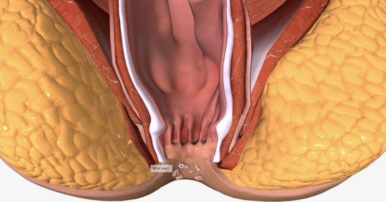 fissure treatment doctor in indore, fissure treatment in indore, fissure surgeon in indore, fissure laser treatment, best fissure treatment doctor in indore, best fissure treatment in indore, best fissure surgeon in indore, best fissure laser treatment