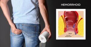 hemorrhoid surgery in indore, hemorrhoid treatment indore, hemorrhoid treatment in indore, best doctor for piles in indore