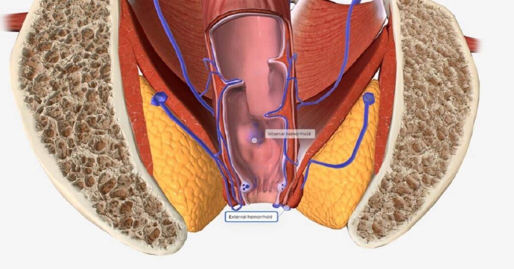 laser piles treatment in indore, advanced laser treatment in indore,
