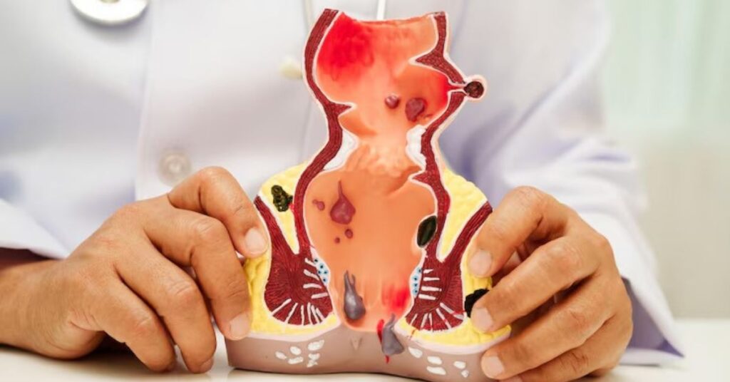 best proctologist in Indore