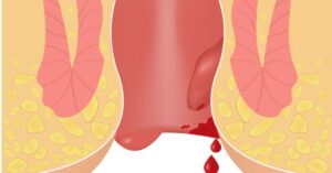 best doctor for piles in indore