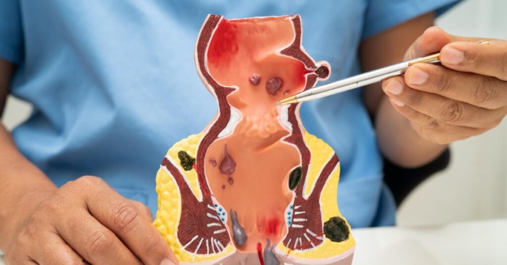 piles dr in indore, best piles dr in indore